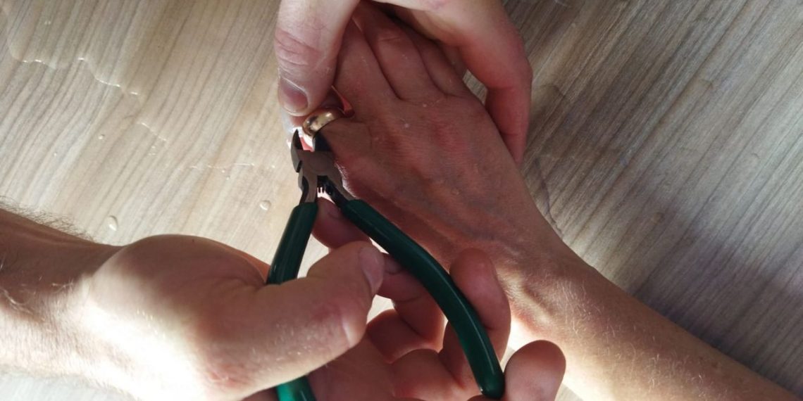 В Новороссийске женщина пришла к спасателям из-за вросшего в палец кольца