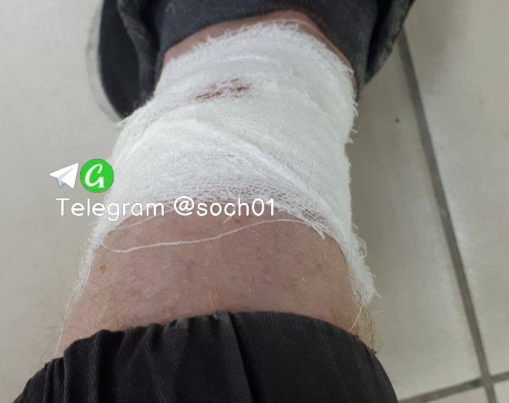 В Сочи бродячая собака напала на мужчину со спины, укусив за ногу