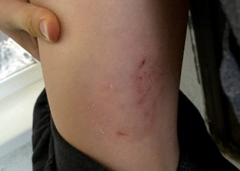 В Краснодаре бездомная собака напала на школьника