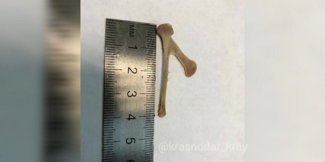 В Новороссийске полуторагодовалый ребенок стал задыхаться из-за куриной кости, застрявшей в пищеводе 