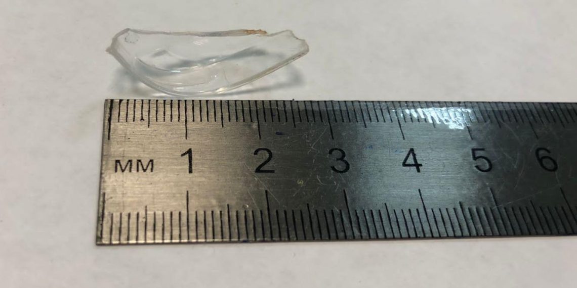 В Новороссийске 11-летний ребенок едва не задохнулся из-за проглоченной автомобильной фары