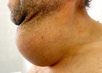 В Краснодаре у чабана удалили гигантскую опухоль