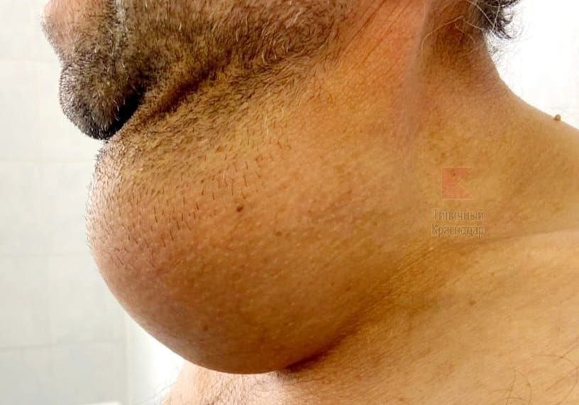 В Краснодаре у чабана удалили гигантскую опухоль