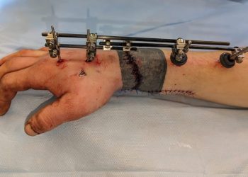 В Краснодаре хирурги пришили парню руку, отрубленную во время колки дров