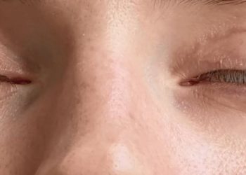 В Краснодаре 25-летняя девушка слепнет и не может сомкнуть веки после пластической операции