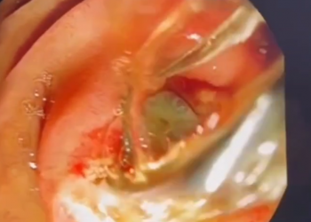 Жительницу Краснодара пожирали черви, а она думала что ее съедает опухоль