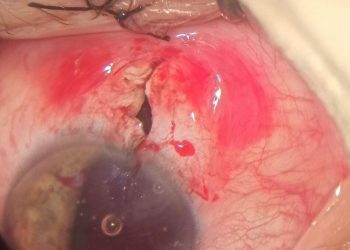 В Новороссийске косивший траву мужчина едва не лишился зрения