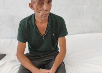 В Краснодаре человек потерял лицо из-за огромной опухоли