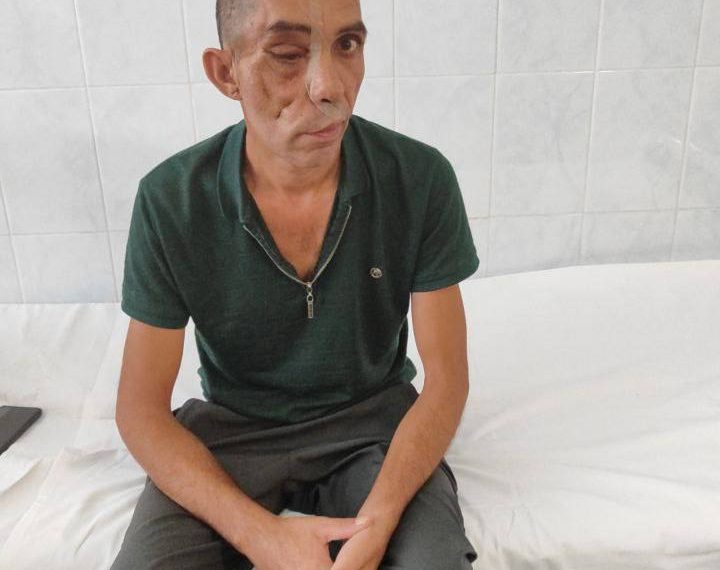 В Краснодаре человек потерял лицо из-за огромной опухоли