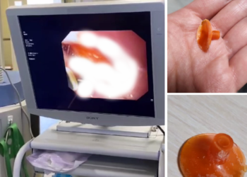 На Кубани 3-летний ребенок 9 месяцев проходил с проглоченной присоской к дротику