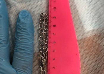 В Новороссийске в кишечнике 5-летнего мальчика нашли браслет длиной 19 см