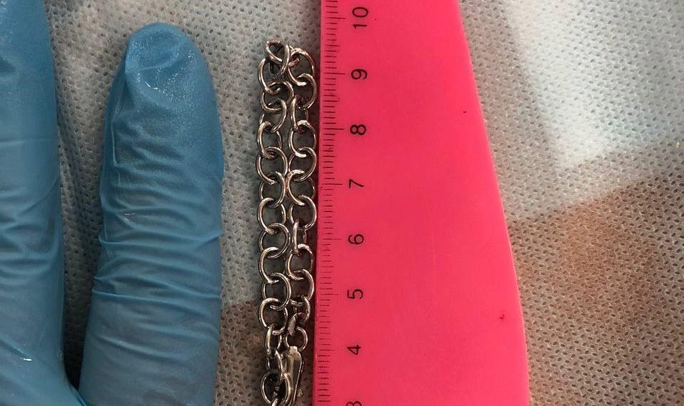 В Новороссийске в кишечнике 5-летнего мальчика нашли браслет длиной 19 см