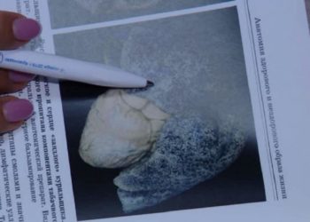 Увлечение вейпами привело жительницу Сочи на больничную койку с тяжелым диагнозом