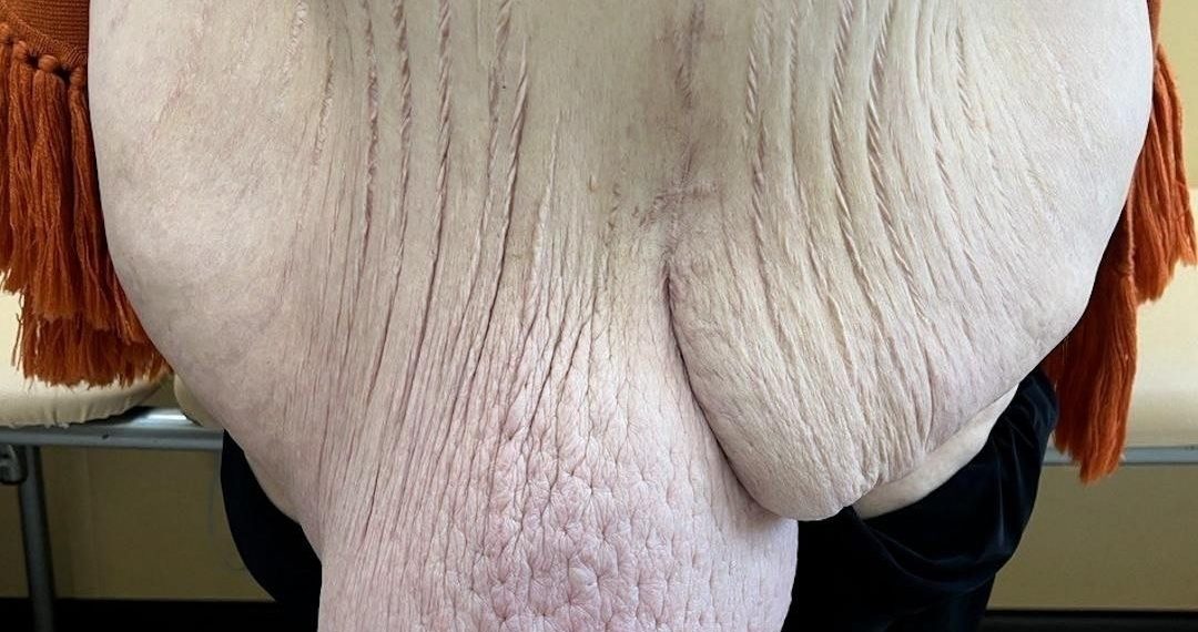 В Краснодаре у худеющей женщины выросла 25-килограммовая грыжа