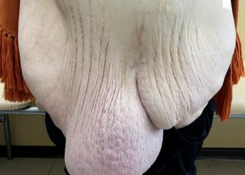 В Краснодаре у худеющей женщины выросла 25-килограммовая грыжа