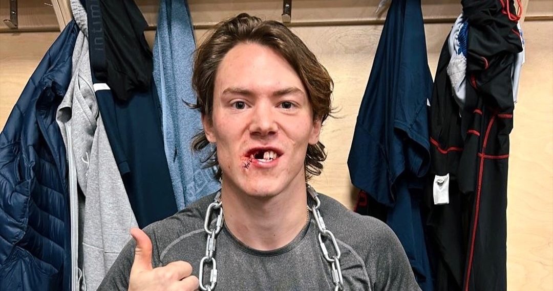 На матче сочинскому хоккеисту выбили несколько зубов