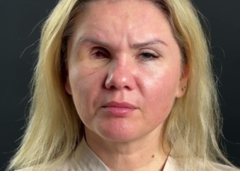 Избитая экс-возлюбленным в Сочи женщина показала, как выглядит без глаза