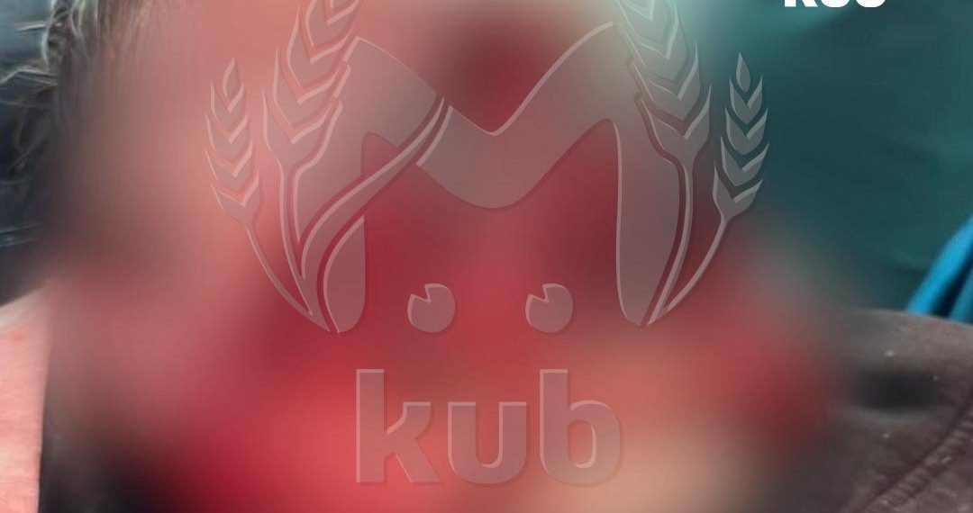 В Сочи две хаски напали и выгрызли часть лица ребенка