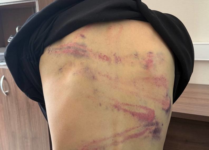 У стендап-комика из Ейска после шутки повреждены легкие и сломан позвонок