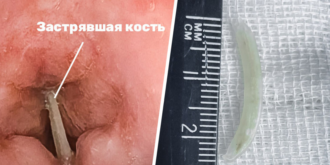Врачи Краснодара спасли мужчину с костью в горле в последний момент