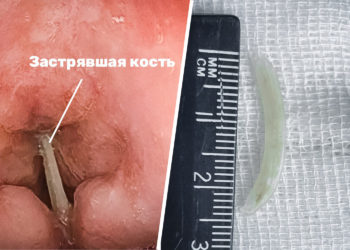 Врачи Краснодара спасли мужчину с костью в горле в последний момент