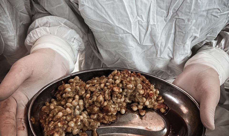 В Краснодаре хирурги извлекли из пациентки ком непереваренной кукурузы