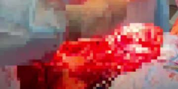 В Адыгее хирурги удалили пациентке опухоль весом 12 килограммов